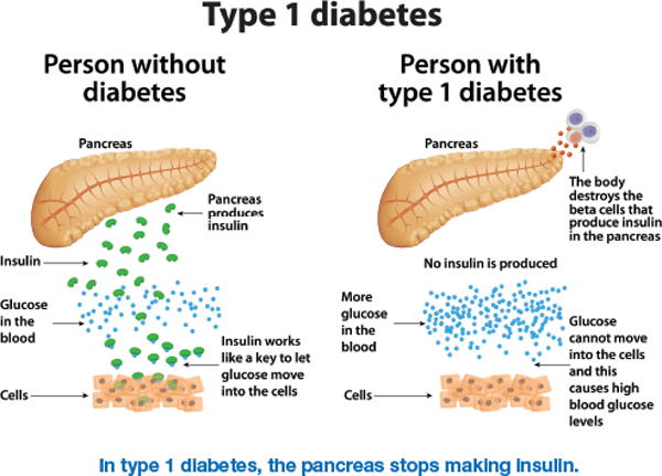 In type 1 diabetes, the pancreas cannot make insulin. This happens because the body&rsquo;s immune system destroys the beta cells in the pancreas. It is the beta cells that make insulin. This results in too much glucose, or sugar, in the bloodstream. If you have type 1 diabetes, you have to replace the insulin your body can no longer make. Insulin is given by injection or by using an insulin pump.  The exact cause of type 1 diabetes is not yet known. Currently, nothing can be done to prevent or cure type 1 diabetes, but researchers are working on this. If type 1 diabetes is managed well, you can continue to lead a healthy life.