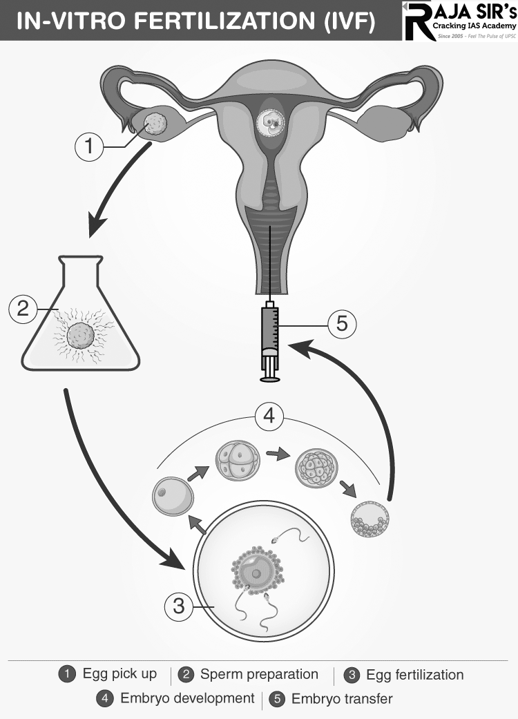 In-Vitro fertilisation procedure: It involves fertilizing an egg outside the body, in a laboratory dish, and then implanting it in a woman&rsquo;s uterus.  Why is there a need?  Infertility is known to affect one in eight couples worldwide. In India alone, infertility affects nearly 10 to 15 per cent of married couples.  In the traditional natural way, the egg gets fertilised by sperms deposited in the vagina, with the most able sperm entering the egg after travelling through the woman&rsquo;s uterus and fallopian tubes. The fertilised egg then divides and forms an embryo in the fallopian tube which then travels back to the uterus to get implanted.  However, if natural or unassisted conception is not possible, fertility treatment is an option.  In an IVF cycle, the sperms that are obtained either from the ejaculated semen sample or sperms that are directly removed from the testis, are either kept in the close vicinity of the egg in petri dishes or are directly injected inside the egg by the embryologist and grown in the lab for five days under the strict supervision of the embryologist (IVF baby&rsquo;s &ldquo;first babysitter&rdquo;). The best looking embryo is selected and transferred by the IVF specialist doctor into the uterus for implantation.  Steps involved for IVF   Suppressing the natural menstrual cycle: The woman receives a drug, usually in the form of a daily injection for about 2 weeks, to suppress their natural menstrual cycle. Super ovulation: Fertility drugs containing the fertility hormone follicle stimulating hormone (FSH) are given to the woman. FSH makes the ovaries produce more eggs than usual. Vaginal ultrasound scans can monitor the process in the ovaries. Retrieving the eggs: The eggs are collected through a minor surgical procedure known as &ldquo;follicular aspiration.&rdquo; A very thin needle is inserted through the vagina and into an ovary. The needle is which is connected to a suction device. This sucks the eggs out. This process is repeated for each ovary.  In 2011, researchers suggested that collecting 15 eggs from the ovaries in one cycle gives the highest chance of a successful pregnancy. Frozen or donated eggs may also be used.  Insemination and fertilization: The eggs that have been collected are placed together with male sperm and kept in an environmentally controlled chamber. After a few hours, the sperm should enter the egg. Sometimes the sperm is directly injected into the egg. This is known as an intracytoplasmic sperm injection (ICSI). Frozen sperm, retrieved through testicular biopsy, may be used. This is believed to be as effective as fresh sperm in achieving a successful pregnancy.  The fertilized egg divides and becomes an embryo. One or two of the best embryos are selected for transfer. The woman is then given progesterone or human chorionic gonadotrophin (hCG) to help the lining of the womb receive the embryo. Embryo transfer: Sometimes, more than one embryo is placed in the womb, if no ideal embryos are available. The transfer of the embryo is done using a thin tube, or catheter. It enters the womb through the vagina. When the embryo sticks to the lining of the womb, healthy embryo growth can begin. The IVF pregnancy is always confirmed with BHCG levels in the blood.  Miscarriages  The incidence of miscarriages is slightly higher in women with IVF pregnancies despite being under strict supervision and receiving more medications than those with a natural pregnancy. The reasons for this are most likely attributed to the higher incidence of elderly women with some medical conditions like diabetes or hypertension, presence of fibroids and higher incidence of aneuploid embryos (embryos with abnormal number of chromosomes).