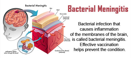 Bacterial meningitis