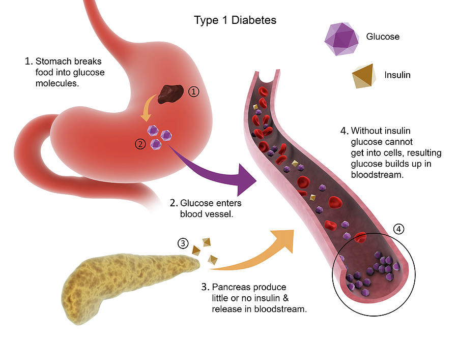 type-1-diabetes