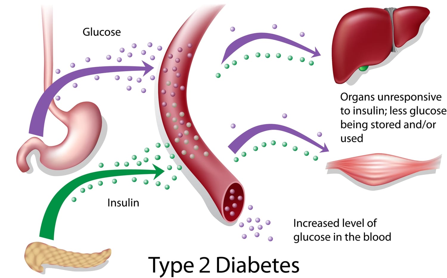 type-2-diabetes